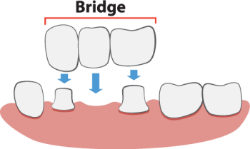 Fuquay-Varina dentist, Dr. McCormick at Fuquay Family Dentistry, shares all you need to know about dental bridges to fill the gap and restore your smile.